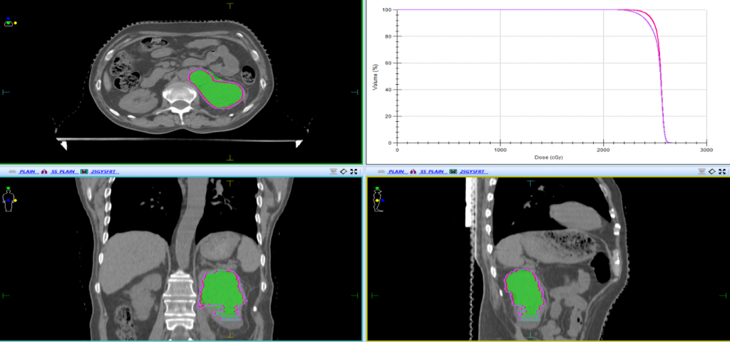 Renal Metastasis in Carcinoma Pyriform Fossa treated with SBRT: A Case ...