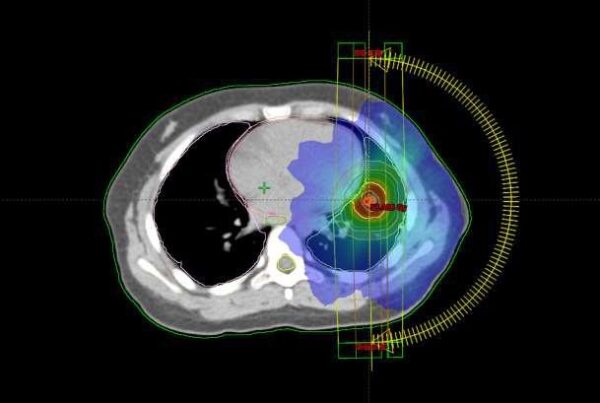 Single Institution Experience - Stereotactic Body Radiotherapy (Sbrt ...